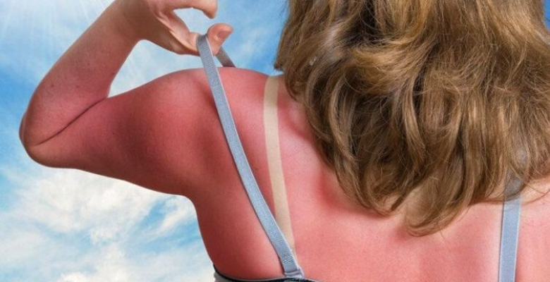 Güneş yanığına ne iyi kazanç salatalıklı yöntemi deneyin! Güneş yanığına ne iyi kazanç salatalıklı yöntemi deneyin!