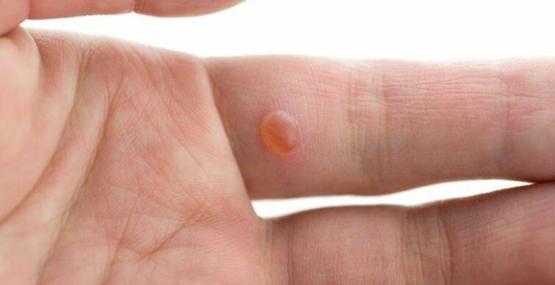 Siğil nedir HPV virüsü siğil yaradılışına neden oluyor! Siğil nedir HPV virüsü siğil yaradılışına neden oluyor!