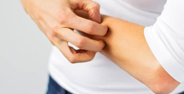 Uyuz nedir şiddetli kaşıntı en ehemmiyetli bulgusu! Uyuz nedir şiddetli kaşıntı en ehemmiyetli bulgusu!