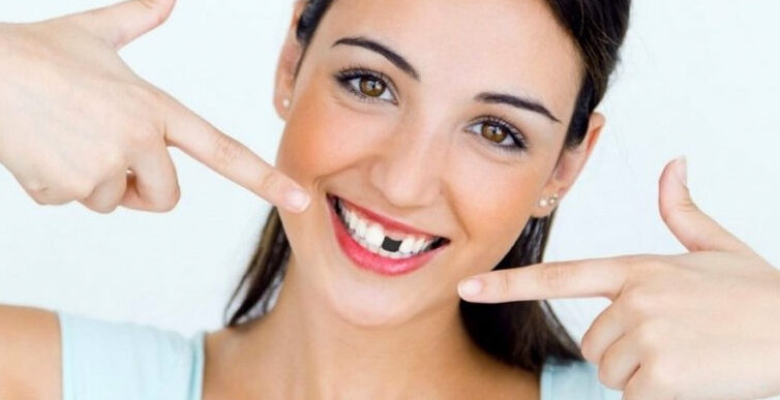 Kaybedilen dişler nasıl bitirilmeli kestirilmeli mi implant mı? Uzmanlar açıklıyor! Kaybedilen dişler nasıl bitirilmeli kestirilmeli mi implant mı? Uzmanlar açıklıyor!