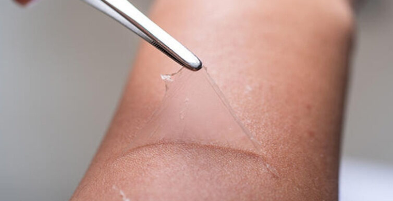 Cilt ceddilmesinin sebepleri neler güneş yanıkları nedeni! Cilt ceddilmesinin sebepleri neler güneş yanıkları nedeni!