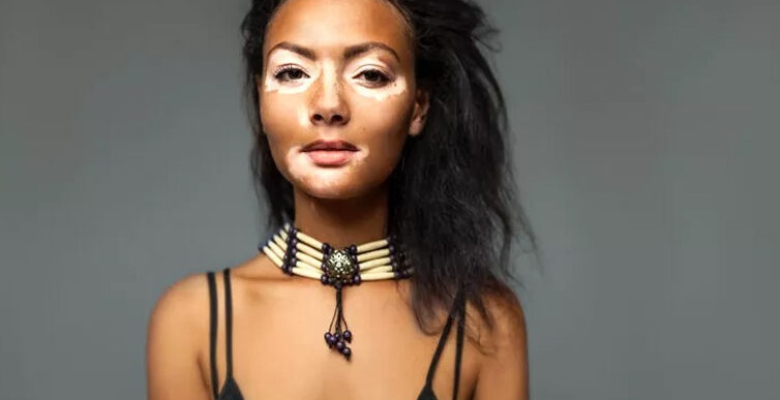 Vitiligo nedir aşırı stres ciltte beyazlıklara yol açıyor! Vitiligo nedir aşırı stres ciltte beyazlıklara yol açıyor!