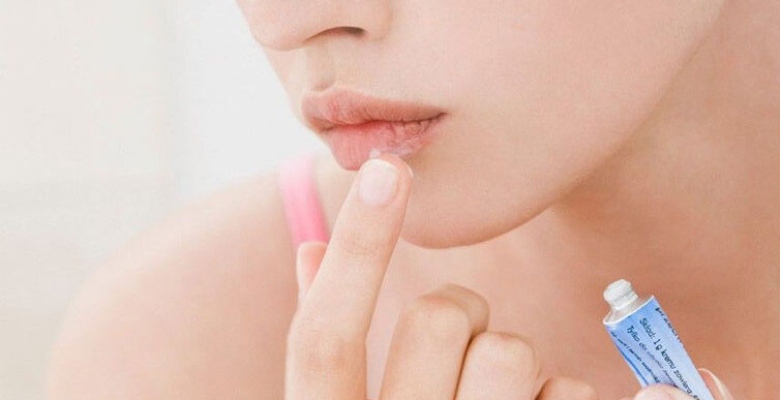 Uçuk nedir neden oluşur ve nasıl geçer? Uçuk nedir neden oluşur ve nasıl geçer?